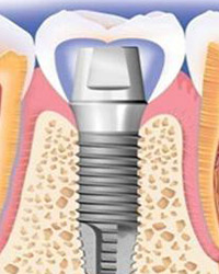 种植牙