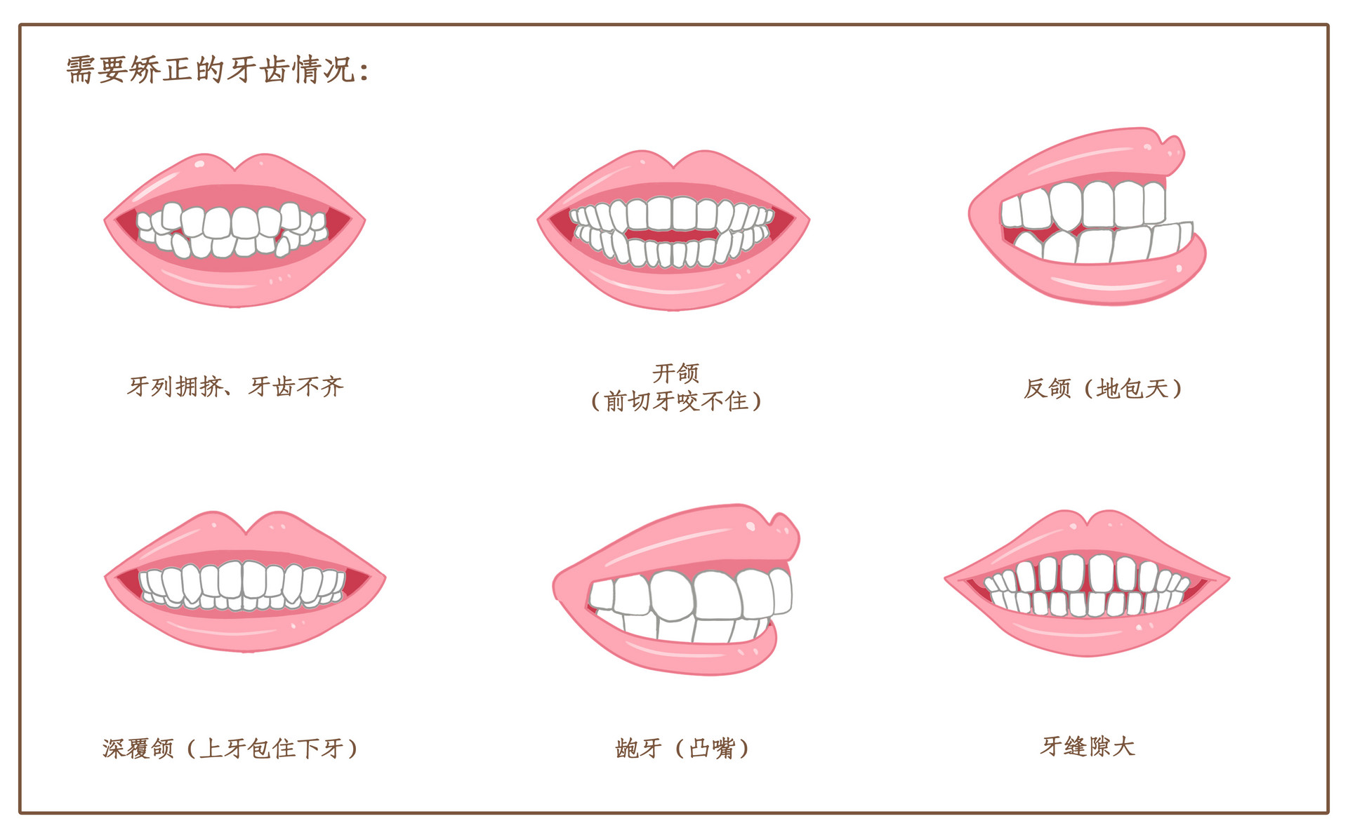 矫正类型.jpg