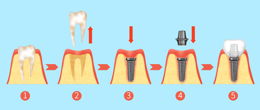 种植牙.jpg