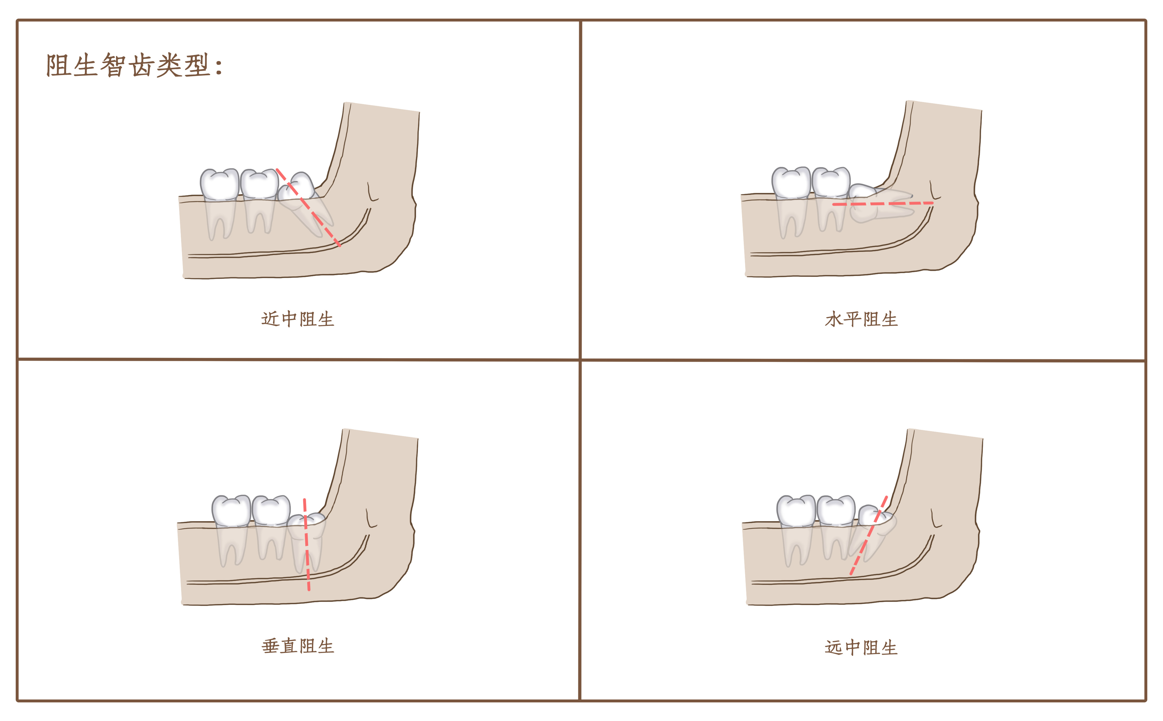 智齿阻生类型.jpg